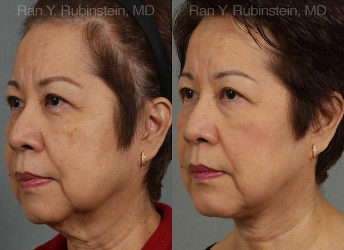 Face lift & Neck lift Before and After Photos in Montvale, NJ, Patient 12641