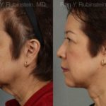Face lift & Neck lift Before and After Photos in Montvale, NJ, Patient 12641