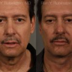 Face lift & Neck lift Before and After Photos in Montvale, NJ, Patient 12673
