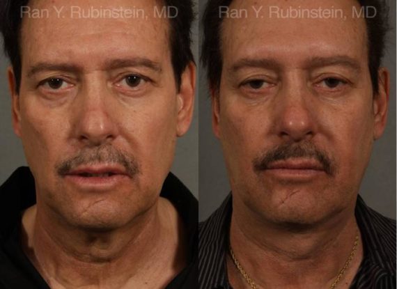 Face lift & Neck lift Before and After Photos in Montvale, NJ, Patient 12673