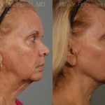 Face lift & Neck lift Before and After Photos in Montvale, NJ, Patient 12678