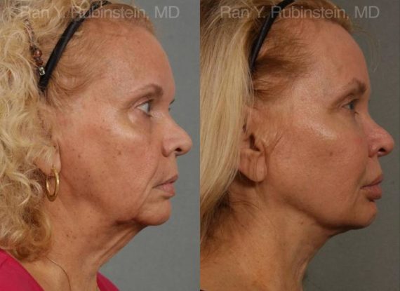 Face lift & Neck lift Before and After Photos in Montvale, NJ, Patient 12678