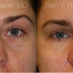 Fat Transfer Before and After Photos in Montvale, NJ, Patient 12686