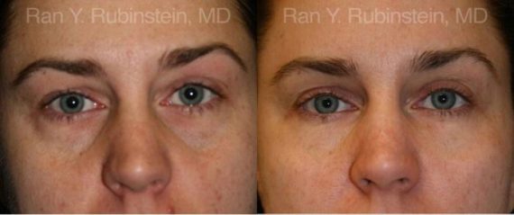 Fat Transfer Before and After Photos in Montvale, NJ, Patient 12686