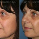 Fat Transfer Before and After Photos in Montvale, NJ, Patient 12689