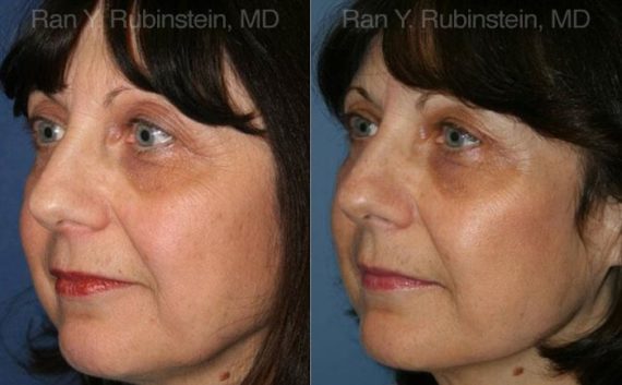 Fat Transfer Before and After Photos in Montvale, NJ, Patient 12689