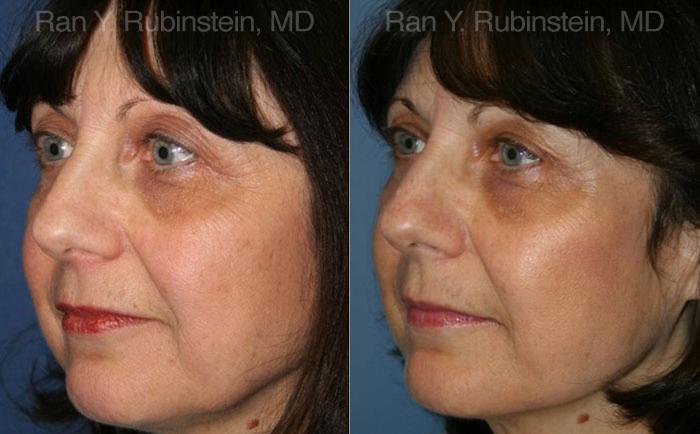 Fat Transfer Before and After Photos in Montvale, NJ, Patient 12689