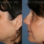 Fat Transfer Before and After Photos in Montvale, NJ, Patient 12689