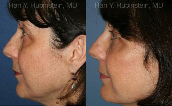 Fat Transfer Before and After Photos in Montvale, NJ, Patient 12689