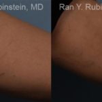 Laser Treatments Before and After Photos in Montvale, NJ, Patient 12807