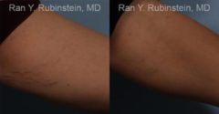 Laser Treatments Before and After Photos in Montvale, NJ, Patient 12807