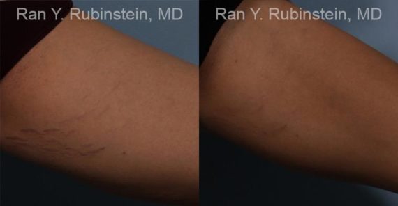 Laser Treatments Before and After Photos in Montvale, NJ, Patient 12807