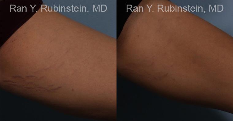 Laser Treatments Before and After Photos in Montvale, NJ, Patient 12807