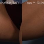 Laser Treatments Before and After Photos in Montvale, NJ, Patient 12807