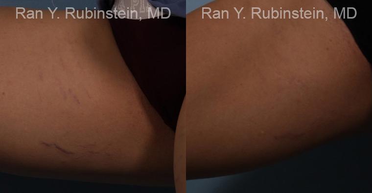 Laser Treatments Before and After Photos in Montvale, NJ, Patient 12807