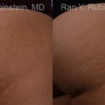 Laser Treatments Before and After Photos in Montvale, NJ, Patient 12812