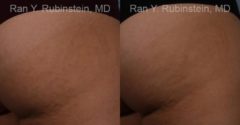 Laser Treatments Before and After Photos in Montvale, NJ, Patient 12812