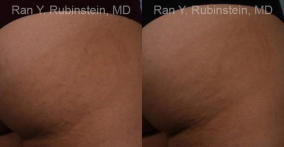 Laser Treatments Before and After Photos in Montvale, NJ, Patient 12812