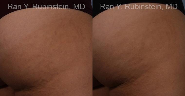 Laser Treatments Before and After Photos in Montvale, NJ, Patient 12812