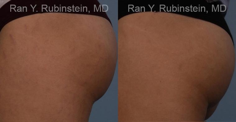 Laser Treatments Before and After Photos in Montvale, NJ, Patient 12812