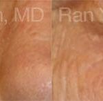 Laser Treatments Before and After Photos in Montvale, NJ, Patient 12836