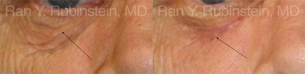 Laser Treatments Before and After Photos in Montvale, NJ, Patient 12836