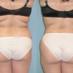Liposuction Before and After Photos in Montvale, NJ, Patient 12870