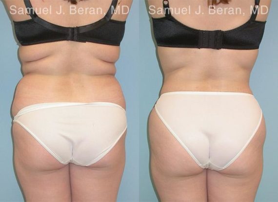 Liposuction Before and After Photos in Montvale, NJ, Patient 12870