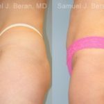 Liposuction Before and After Photos in Montvale, NJ, Patient 12873