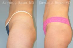 Liposuction Before and After Photos in Montvale, NJ, Patient 12873
