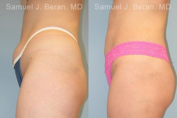 Liposuction Before and After Photos in Montvale, NJ, Patient 12873