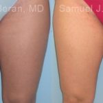 Liposuction Before and After Photos in Montvale, NJ, Patient 12876