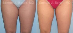 Liposuction Before and After Photos in Montvale, NJ, Patient 12876