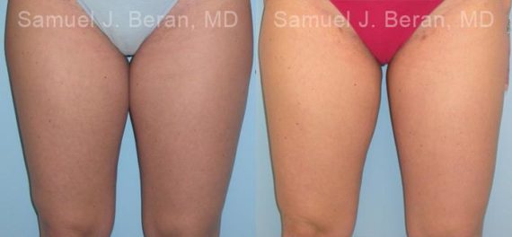 Liposuction Before and After Photos in Montvale, NJ, Patient 12876
