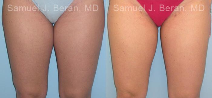 Liposuction Before and After Photos in Montvale, NJ, Patient 12876