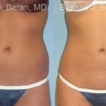 Liposuction Before and After Photos in Montvale, NJ, Patient 12879
