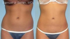 Liposuction Before and After Photos in Montvale, NJ, Patient 12879