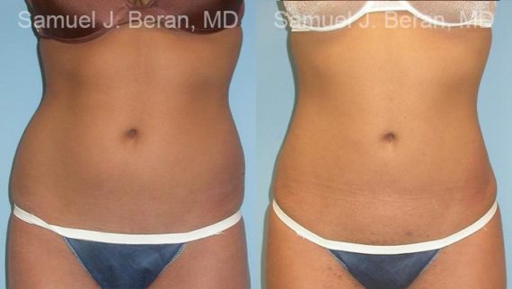 Liposuction Before and After Photos in Montvale, NJ, Patient 12879