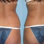 Liposuction Before and After Photos in Montvale, NJ, Patient 12879
