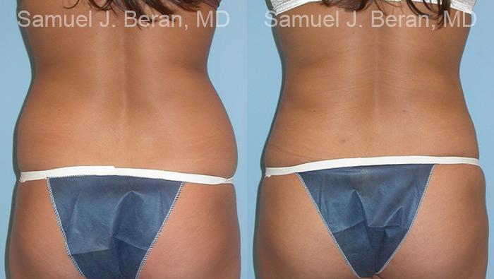 Liposuction Before and After Photos in Montvale, NJ, Patient 12879