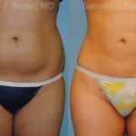 Liposuction Before and After Photos in Montvale, NJ, Patient 12884