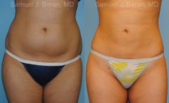 Liposuction Before and After Photos in Montvale, NJ, Patient 12884