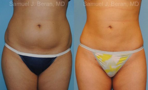 Liposuction Before and After Photos in Montvale, NJ, Patient 12884