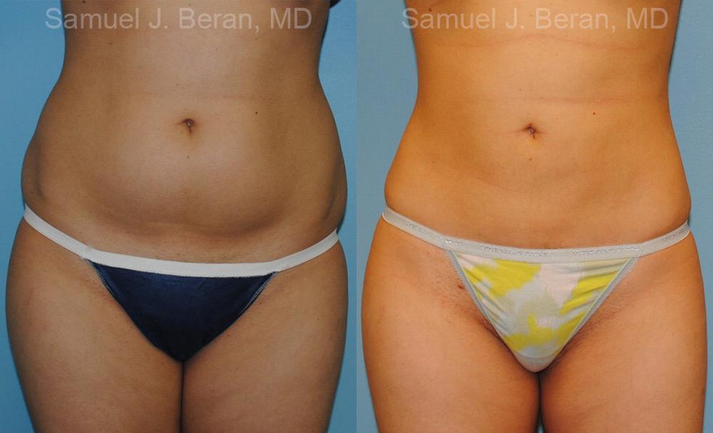 Liposuction Before and After Photos in Montvale, NJ, Patient 12884