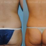 Liposuction Before and After Photos in Montvale, NJ, Patient 12884