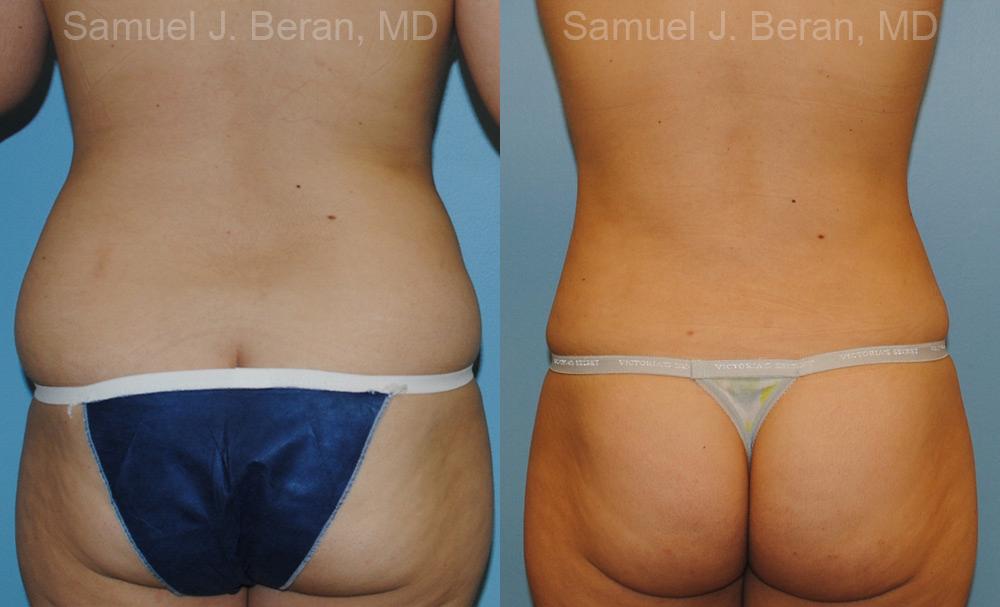 Liposuction Before and After Photos in Montvale, NJ, Patient 12884