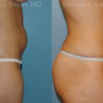 Liposuction Before and After Photos in Montvale, NJ, Patient 12884