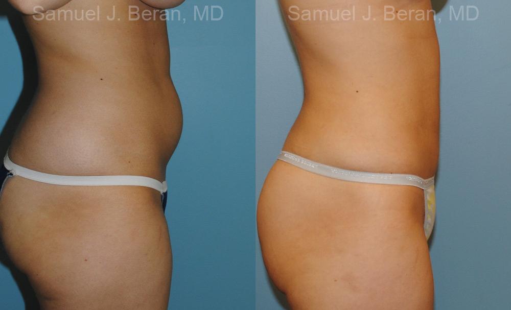 Liposuction Before and After Photos in Montvale, NJ, Patient 12884
