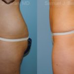 Liposuction Before and After Photos in Montvale, NJ, Patient 12884