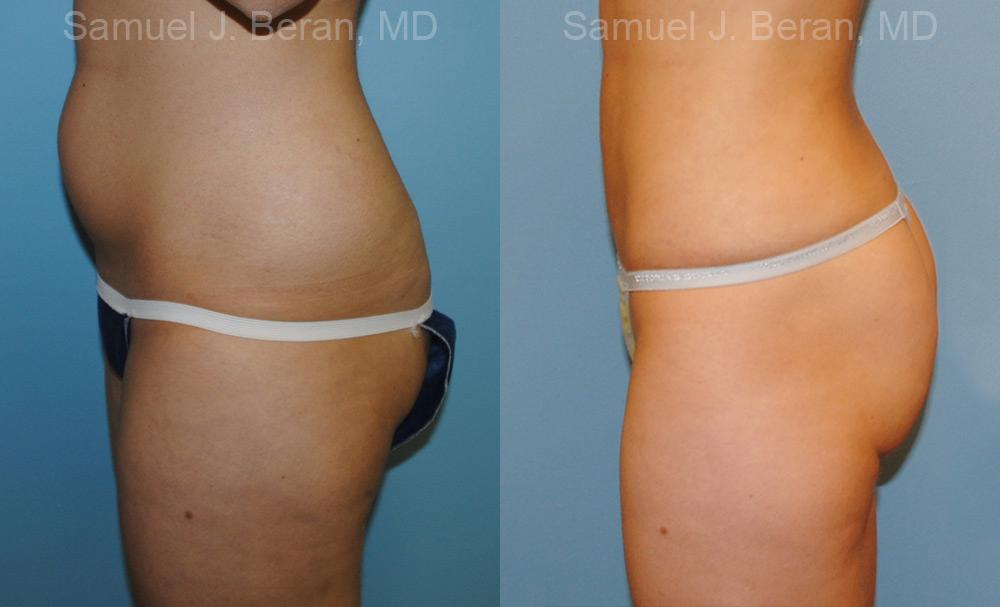 Liposuction Before and After Photos in Montvale, NJ, Patient 12884